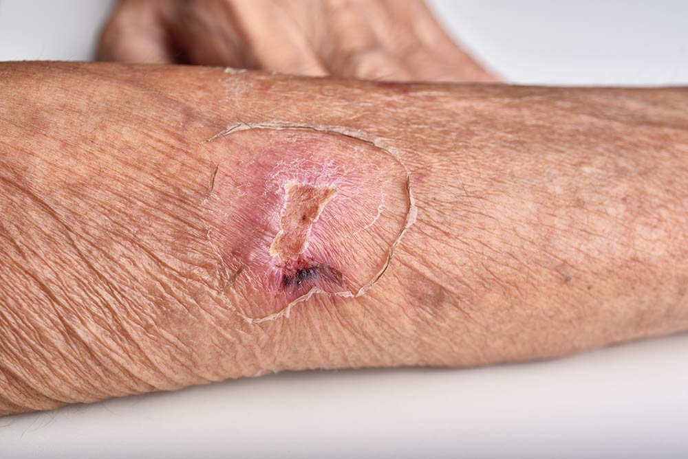 chronic wound on senior people wrist arm skin at wundzentrum berlin