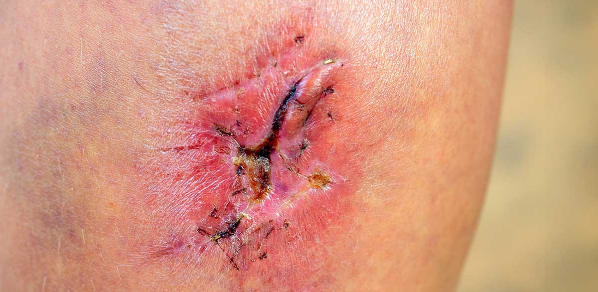 close up of cyanotic keloid scar chronic surgery wundzentrum berlin