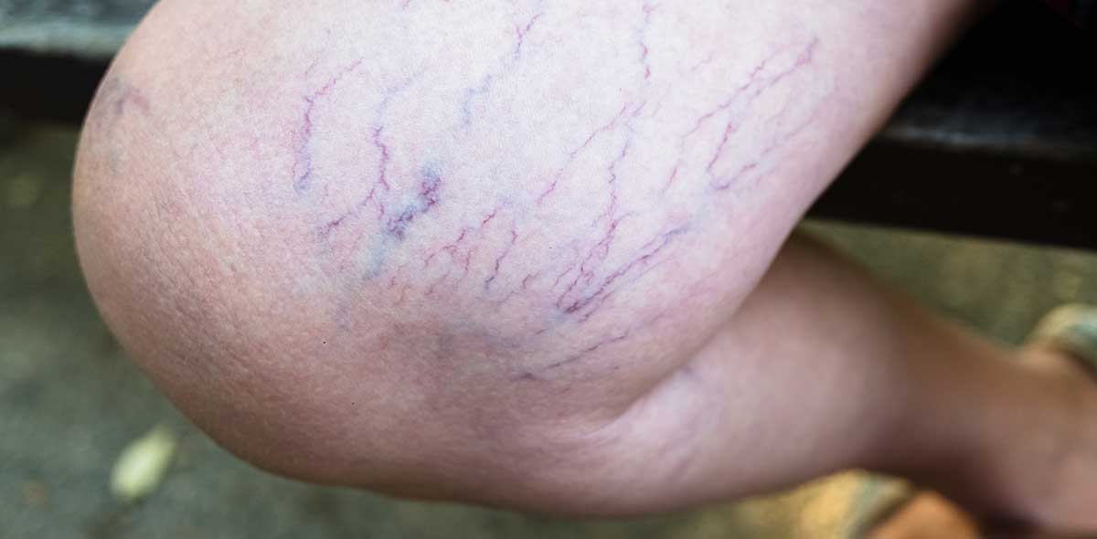 detail of spider veins on the leg of patient in venaziel berlin veincenter