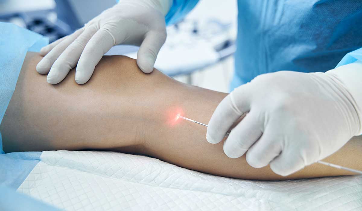 doctor phlebologist is performing endovenous laser therapy in veincenter berlin venaziel