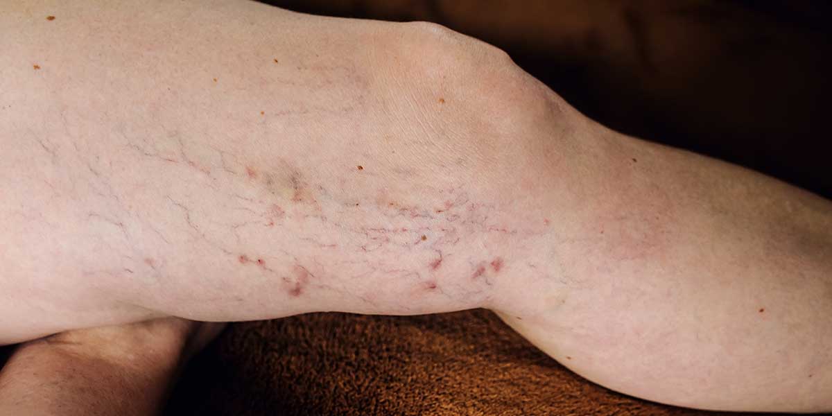 the disease spider veins and varicose veins on a young womans legs veincenter berlin venaziel