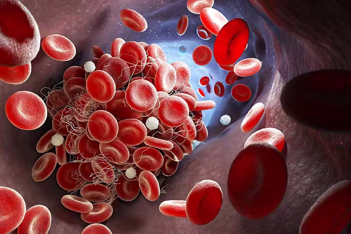 formation-of-blood-clot-invein-causing-thrombosis-and-varicose-veins-2 formation-of-blood-clot-invein-causing-thrombosis-and-varicose-veins