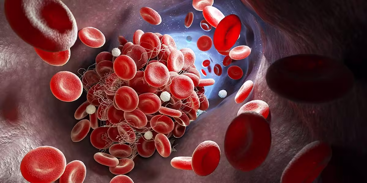 formation-of-blood-clot-invein-causing-thrombosis-and-varicose-veins formation-of-blood-clot-invein-causing-thrombosis-and-varicose-veins
