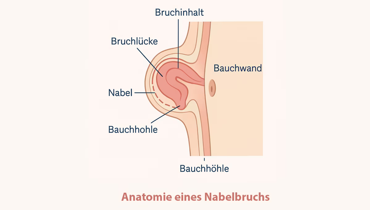 Nabelbruch (Hernia umbilicalis): Ursachen, Symptome und moderne Behandlung 4 Anatomie-eines-Nabelbruchs-minimalinvasive-behandlungen-berlin-venaziel