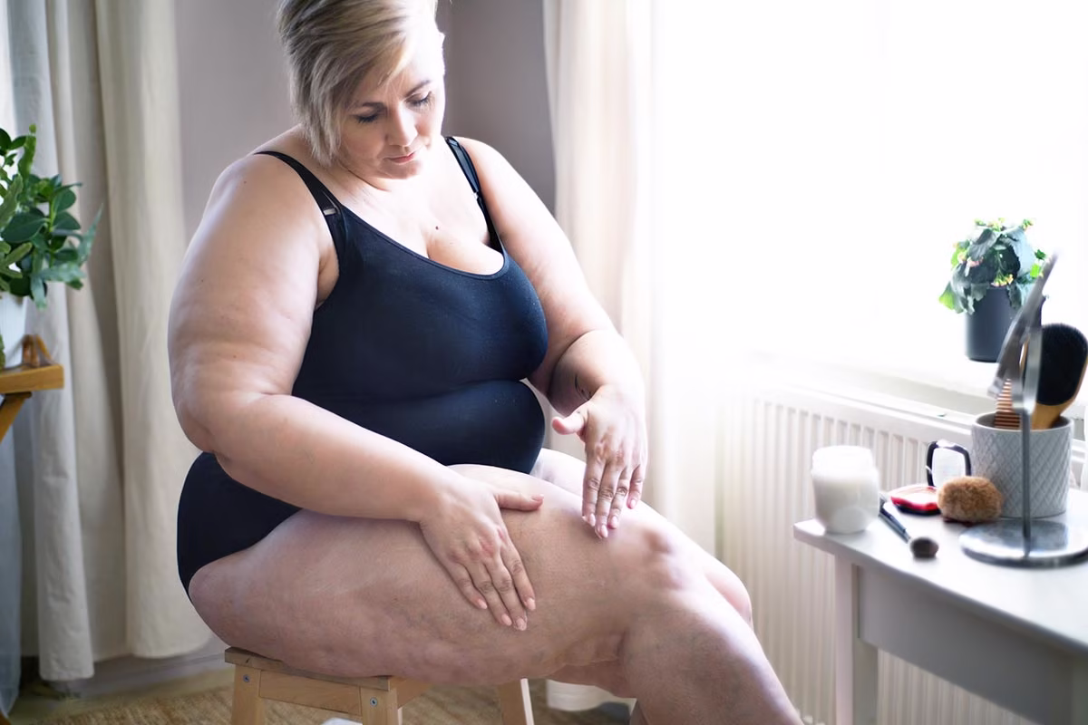 Frau-waehrend-einer-Liposuktion-zur-Behandlung-eines-Lipoedems-moderne-schonende-Methode-zur-Reduktion-krankhafter-Fettverteilungsstoerung-in-berlin-kreuzberg-venaziel-lipoedemzentrum Frau während einer Liposuktion zur Behandlung eines Lipödems – moderne, schonende Methode zur Reduktion krankhafter Fettverteilungsstörung in berlin kreuzberg venaziel lipödemzentrum