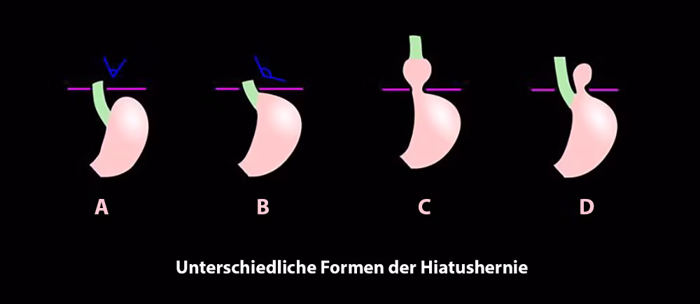 Hiatushernie (Zwerchfellbruch) – Ursachen, Symptome und Behandlung in Berlin 5 Unterschiedliche-Formen-der-Hiatushernie-venaziel-hernienzentrum-minimalinvasiv-op-berlin