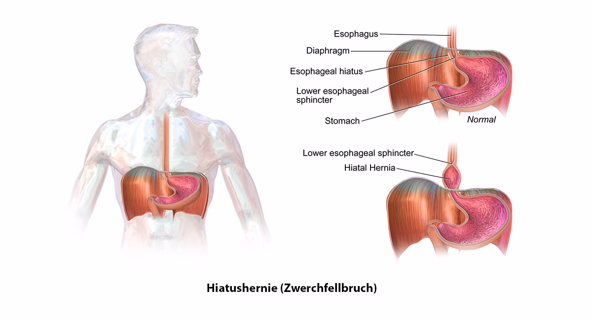 Hiatushernie (Zwerchfellbruch) – Ursachen, Symptome und Behandlung in Berlin 4 Zwerchfellbruch-hiatushernie-anatomie-was-ist-das-definition-Venaziel-op-mvz-berlin