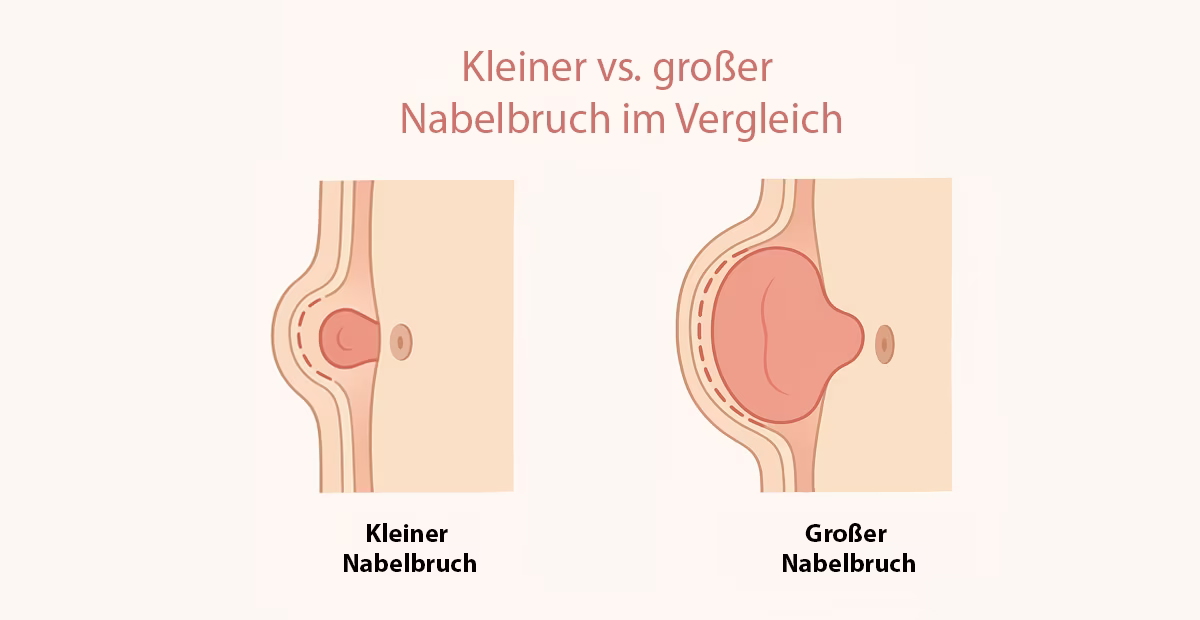 Nabelbruch (Hernia umbilicalis): Ursachen, Symptome und moderne Behandlung 5 kleiner-vs-grosser-nabelbruch-im-vergleich-minimalinvasive-behandlungen-berlin-venaziel