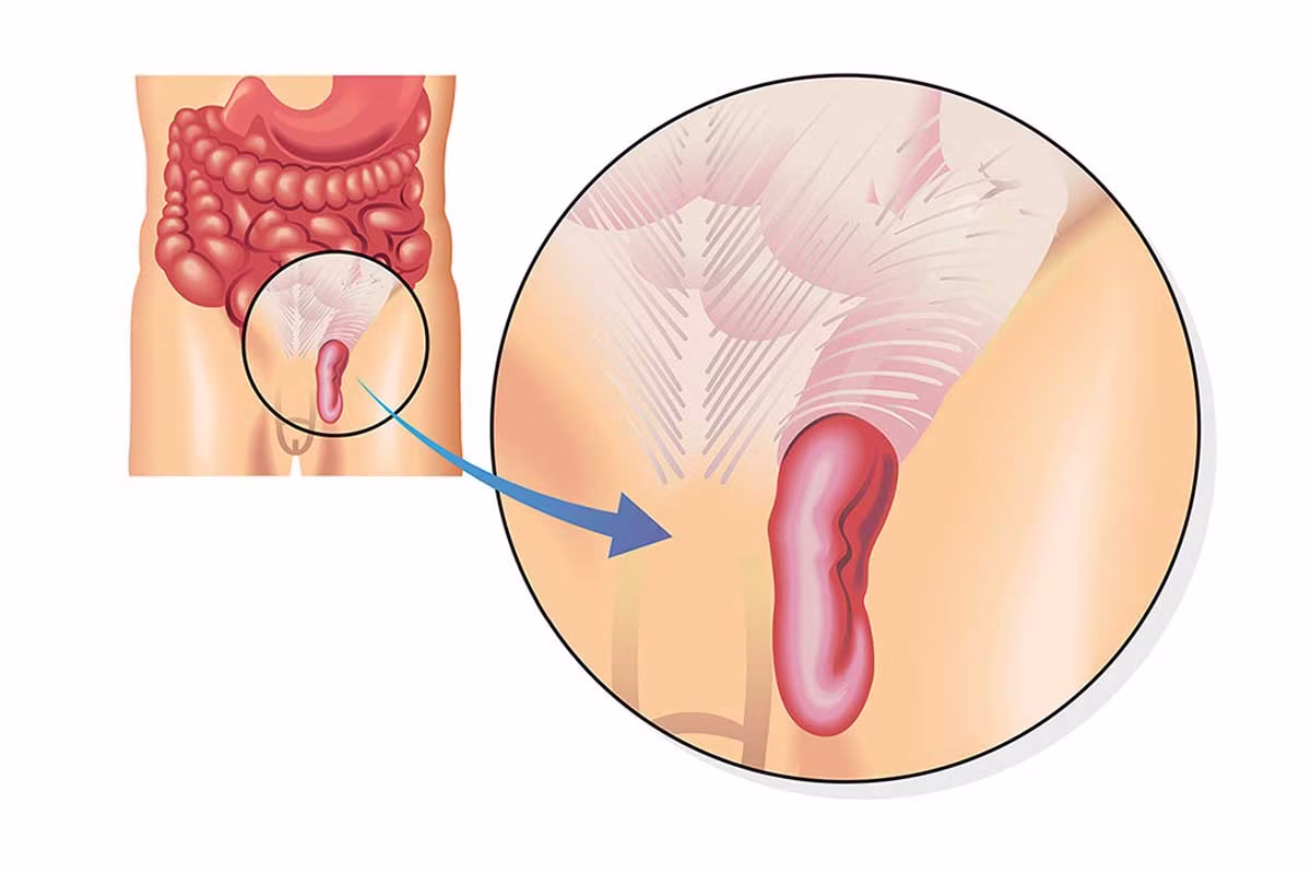 hernia-dangerous-surgery-berlin
