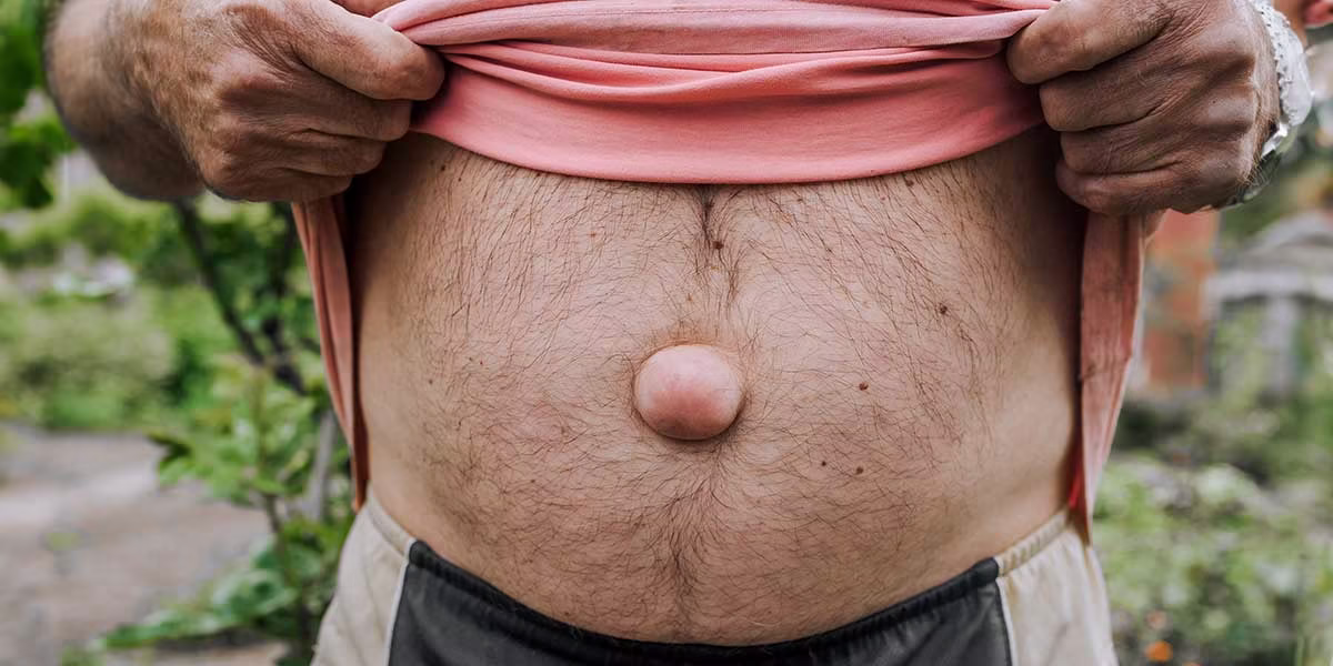 nabelbruch-oder-nabelhernie-behandlung-berlin-mitte-hernienzentrum-minimal-ivasiv Minimalinvasive Behandlung eines Nabelbruchs im Hernienzentrum Berlin-Mitte