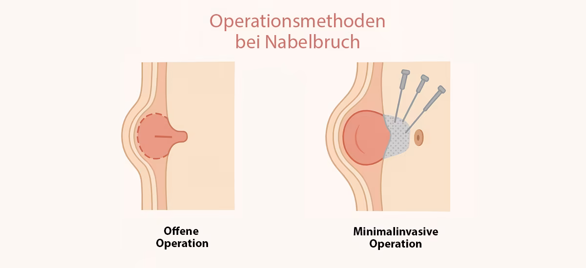 Nabelbruch (Hernia umbilicalis): Ursachen, Symptome und moderne Behandlung 6 operationmethoden-bein-nabelbruch-offene-vs-minimalinvasive-op-im-vergleich-minimalinvasive-behandlungen-berlin-venaziel