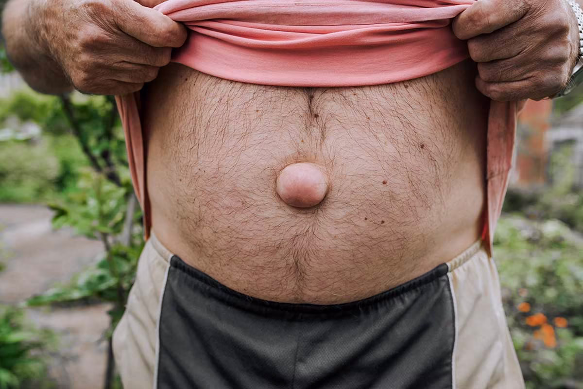 operationmethoden-bein-nabelbruch-offene-vs-minimalinvasive-op-im-vergleich-minimalinvasive-behandlungen-berlin-venaziel-mvz operationmethoden-bein-nabelbruch-offene-vs-minimalinvasive-op-im-vergleich-minimalinvasive-behandlungen-berlin-venaziel-mvz