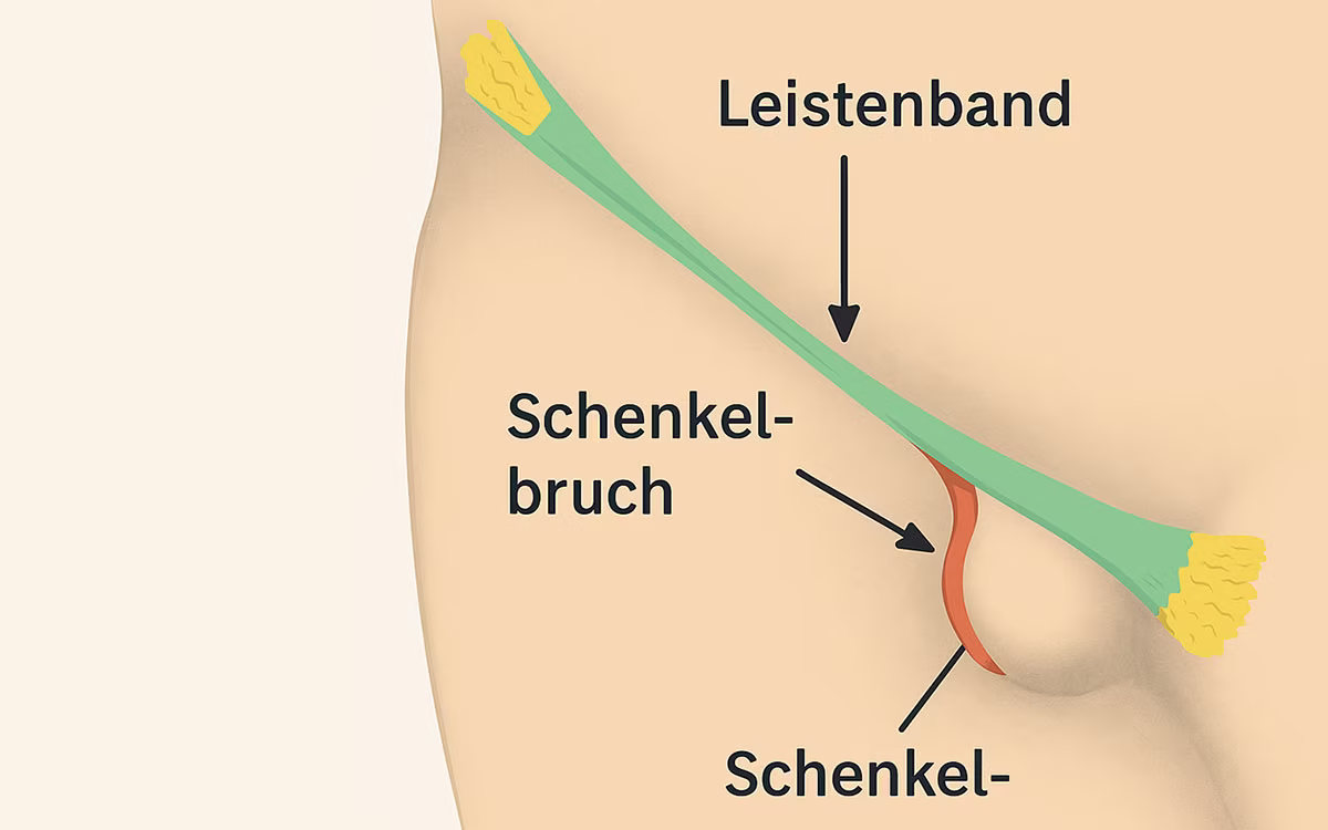 Małoinwazyjne leczenie przepukliny udowej: delikatnie, bezpiecznie i ambulatoryjnie 4 przepuklina-udowa-anatomia-venaziel-berlin-centrum-przepuklin-sala-operacyjna