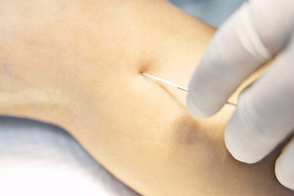 close-up-modern-varicose-vein-treatment-radiowelle-radiofrequenz-venenzentrum close up modern varicose vein treatment radiowelle radiofrequenz venenzentrum