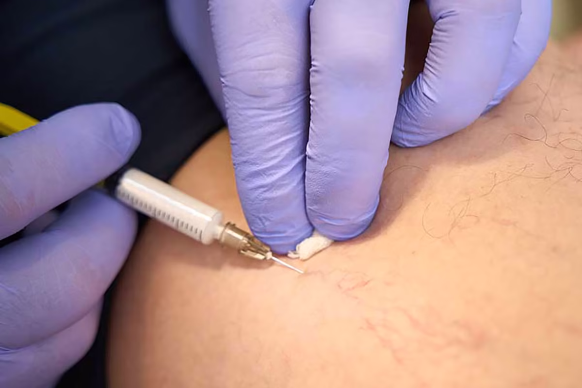 treatment-of-spider-veins-venenzentrum-berlin-mikroschaum-venenzentrum treatment of spider veins venenzentrum berlin mikroschaum venenzentrum