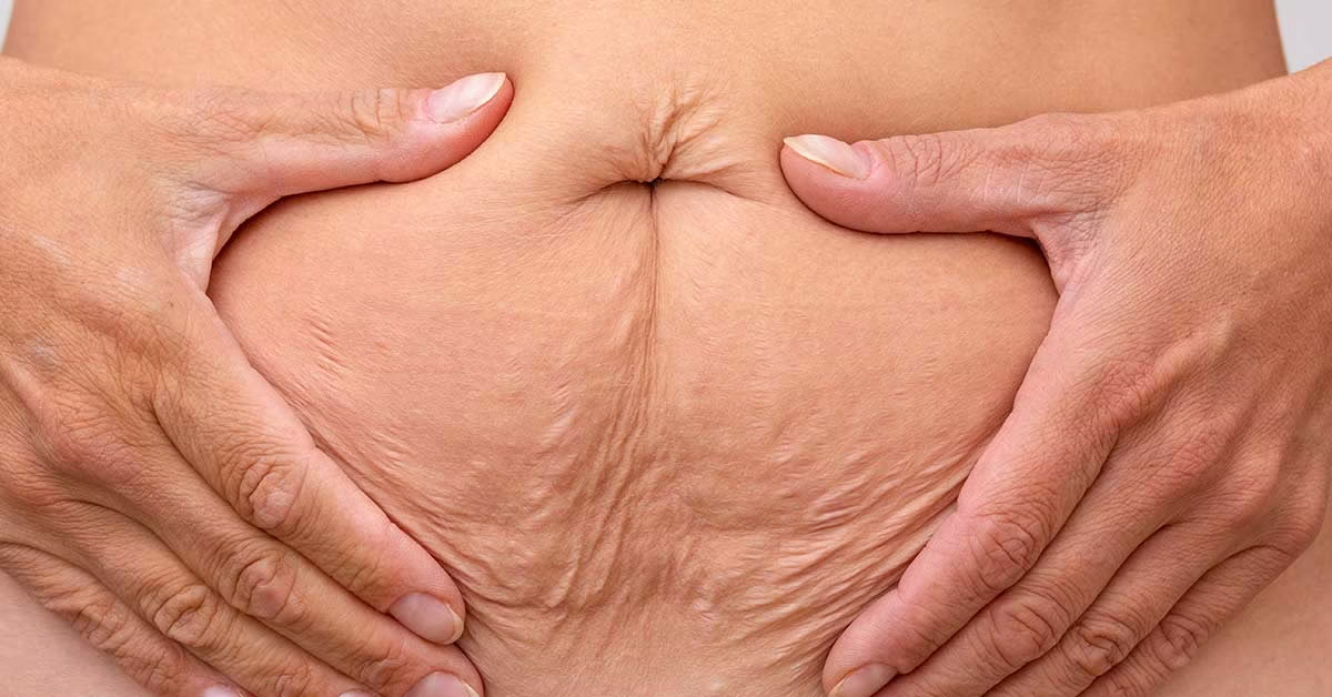 Liposuccion précise et raffermissement efficace de la peau sans scalpel en une seule étape – VASER® & Renuvion®&nbsp;: la méthode de bodyforming high-tech
