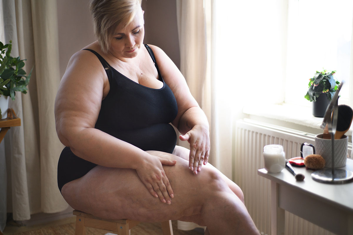  was-ist-ein-lipoedem-venaziel-berlin-MVZ-minimal-invasive-behandlungen