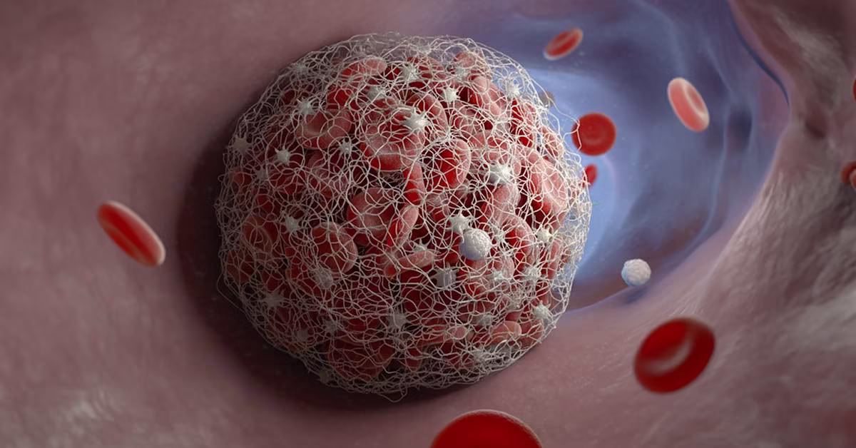 venenthrombose-behandlung-stille-gefahr venenthrombose behandlung stille gefahr