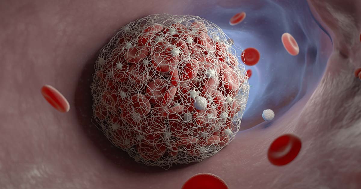 venenthrombose behandlung stille gefahr