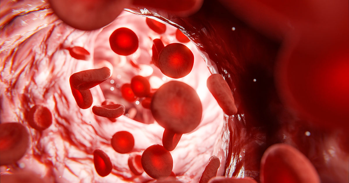 postthrombotisches syndrum pts ivus 1