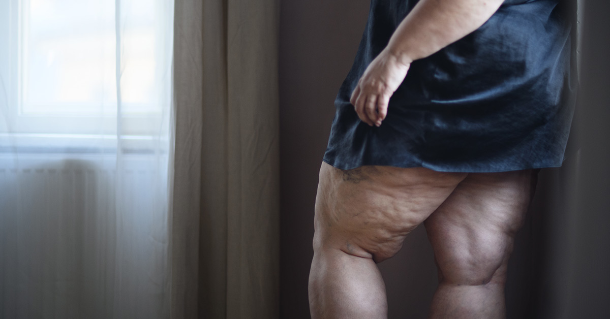 Phlebologische Abklärung vor Liposuktion: Warum die Venen zuerst geprüft werden 5 phlebologische-abklaerung-vor-liposuktion-venaziel-venenzentrum
